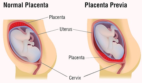 Spotting During Pregnancy 10