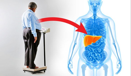 Non Alcoholic Fatty liver