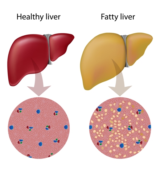 fatty liver symptoms and causes