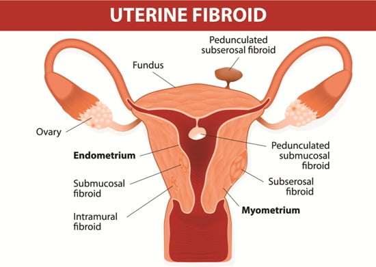 fibroids