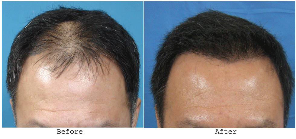 Hair Transplant In Bangalore