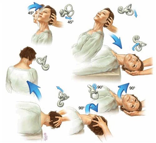 Epley Maneuver For Vertigo