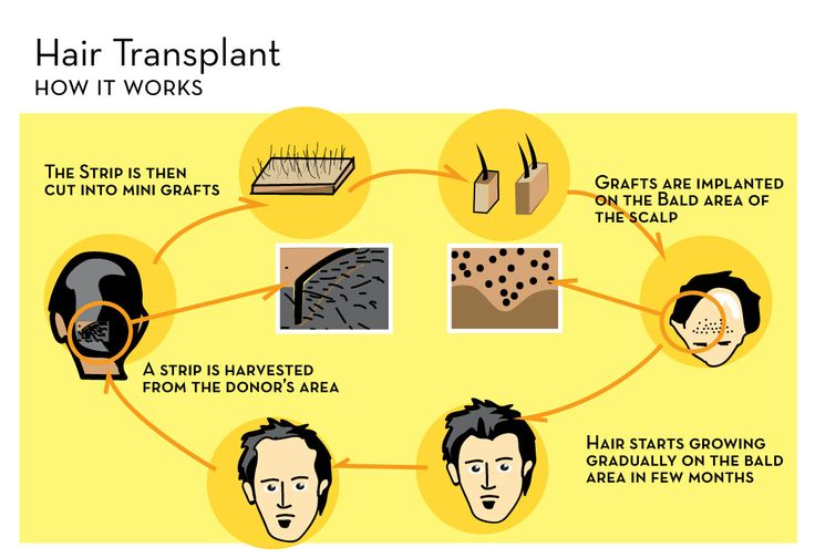 hair transplant in delhi