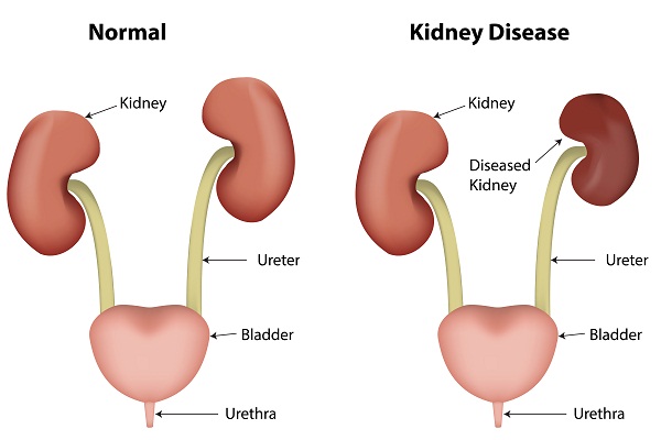 Kidney problems for gaining weight