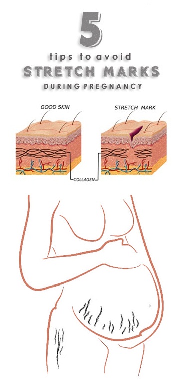 stretch marks during pregnancy