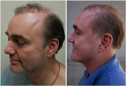 hair transplantation centres in Pune