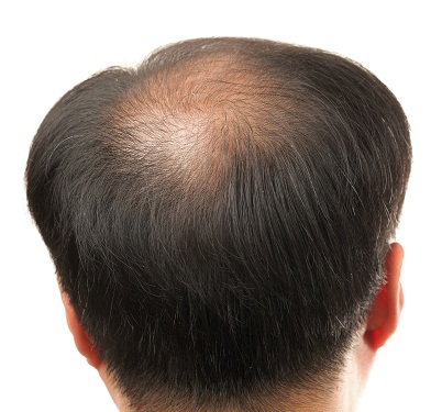 Alopecia Areata