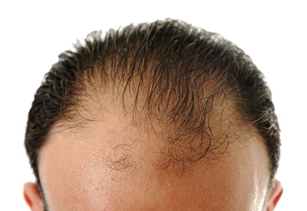 Hereditary Hair Loss