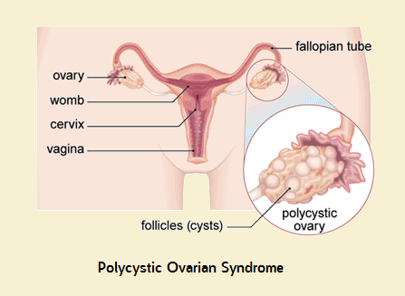 Polycystic Ovarian Syndrome