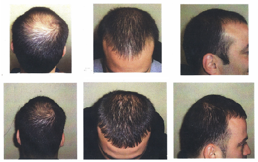 laser-treatment-for-hair-loss